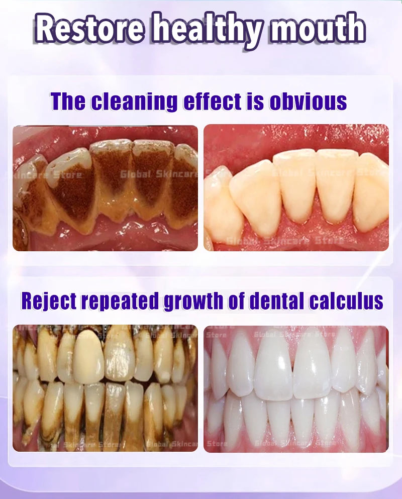 Tartar removers dissolves tartar and eliminates stains