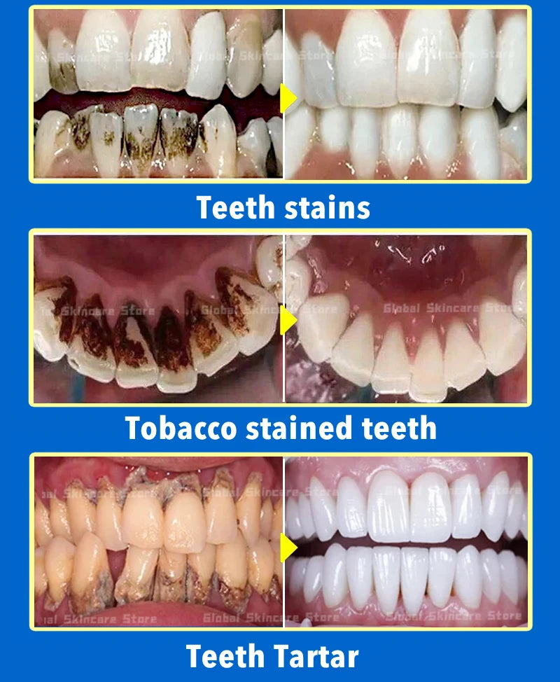 Tartar removers dissolves tartar and eliminates stains