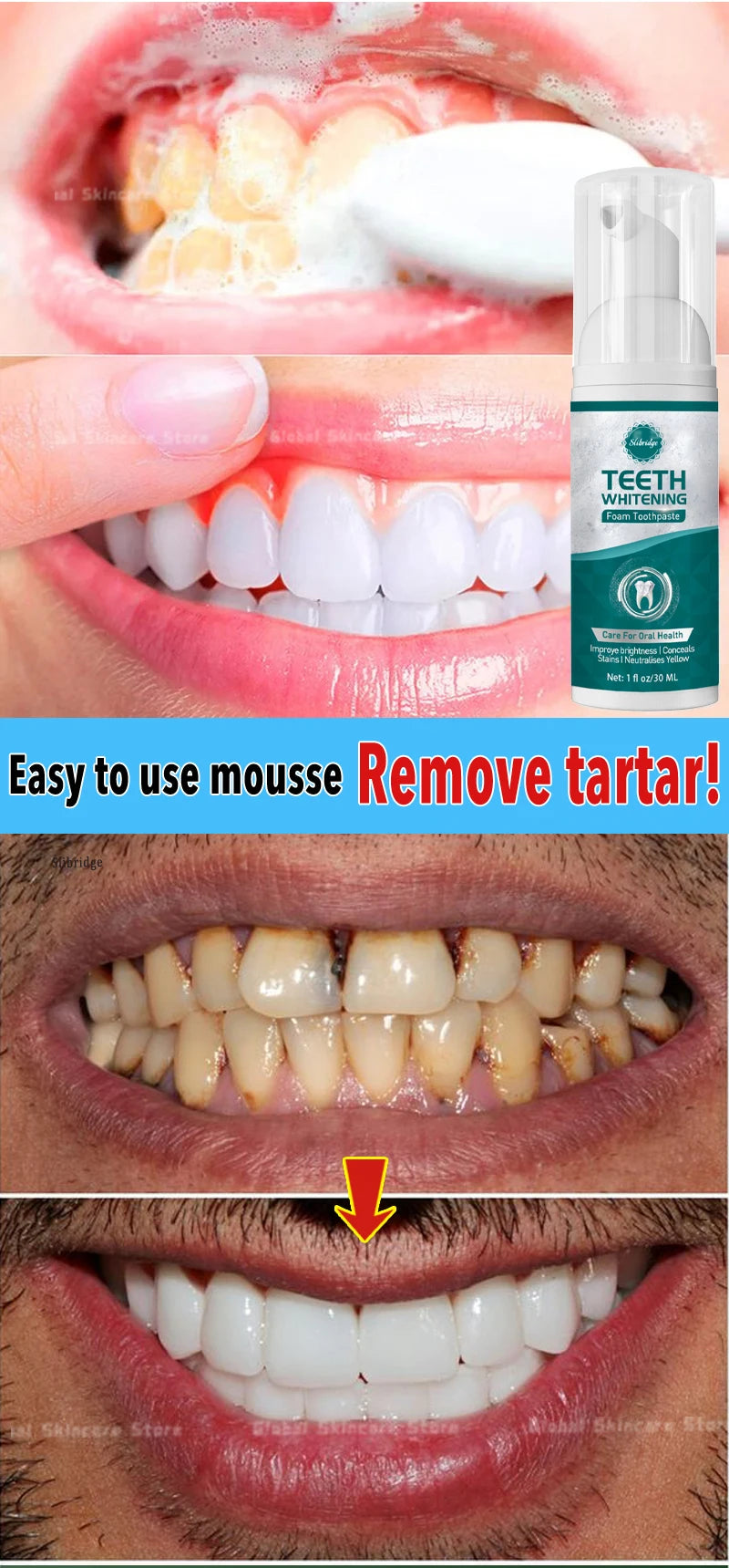 Tartar removers dissolves tartar and eliminates stains