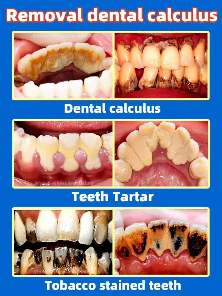 Tartar removers dissolves tartar and eliminates stains