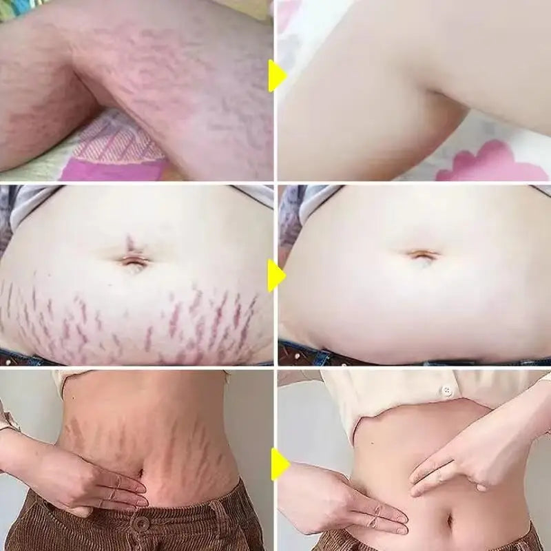Stretch Marks Permanent Removal Cream Maternity Pregnant Women Pregnancy Anti-Winkle Smooth Repair Firming Skin Body Skin Care