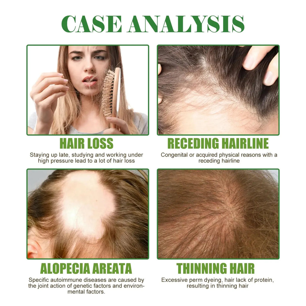 Eelhoe Rosemary Hair & Scalp Oil with Brush Rosemary Scalp Treatment Oil with Applicator Brush Nova Trendz