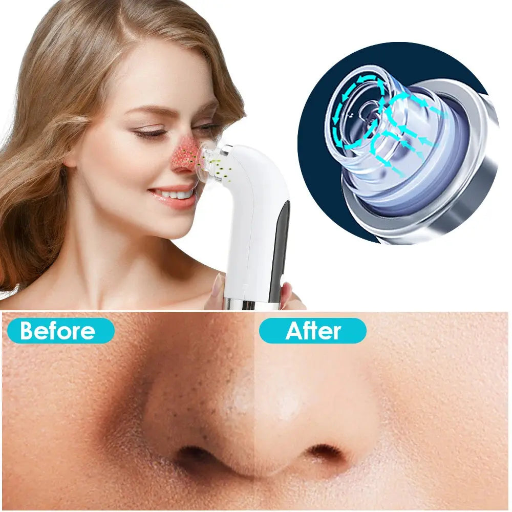 Blackhead Remover Nose T Zone Pore Vacuum Acne Pimple Removal Vacuum Suction Tool Facial Diamond Dermabrasion Machine Face Clean Nova Trendz