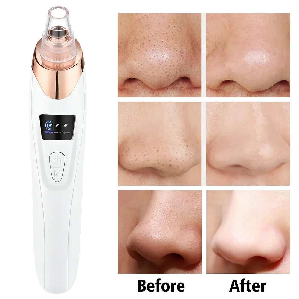 Blackhead Remover Nose T Zone Pore Vacuum Acne Pimple Removal Vacuum Suction Tool Facial Diamond Dermabrasion Machine Face Clean Nova Trendz