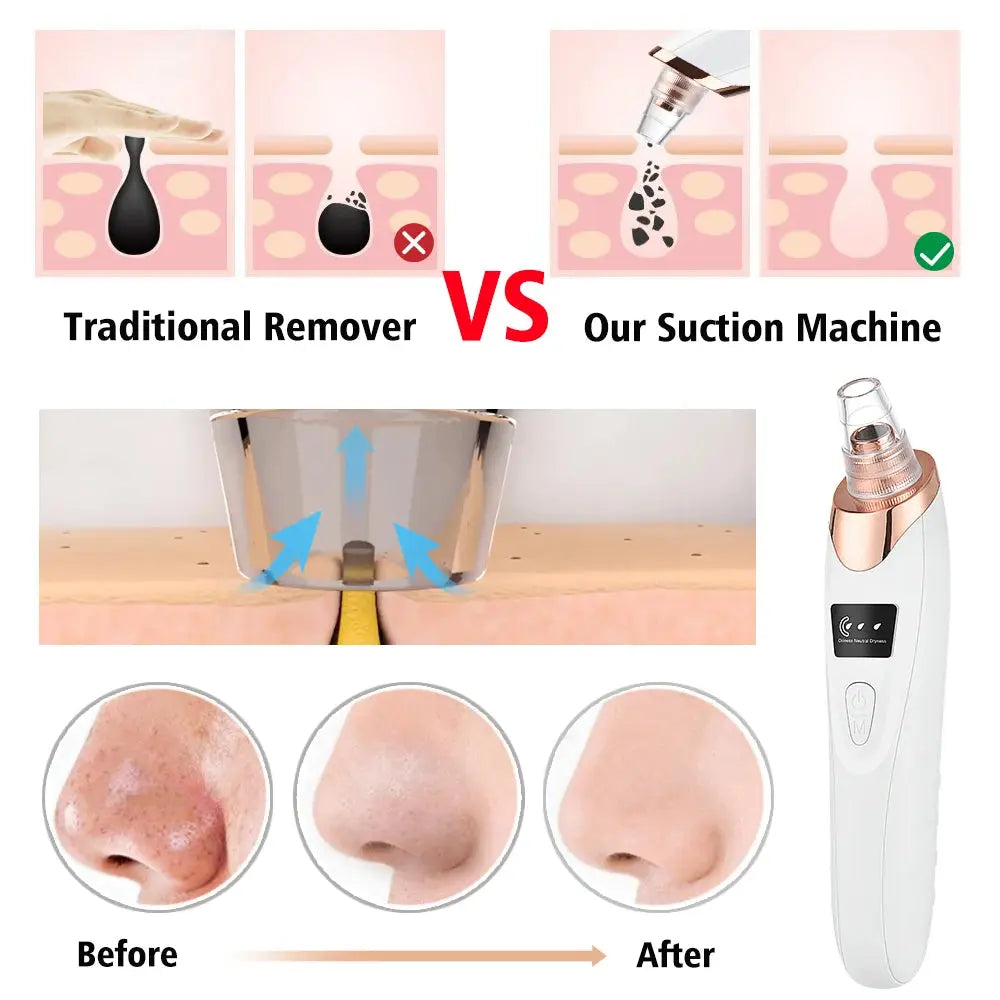 Blackhead Remover Nose T Zone Pore Vacuum Acne Pimple Removal Vacuum Suction Tool Facial Diamond Dermabrasion Machine Face Clean Nova Trendz