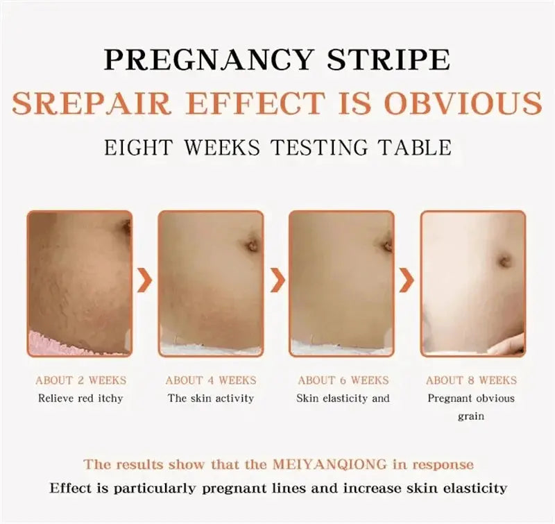 Stretch Marks Permanent Removal Cream Maternity Pregnant Women Pregnancy Anti-Winkle Smooth Repair Firming Skin Body Skin Care Nova Trendz