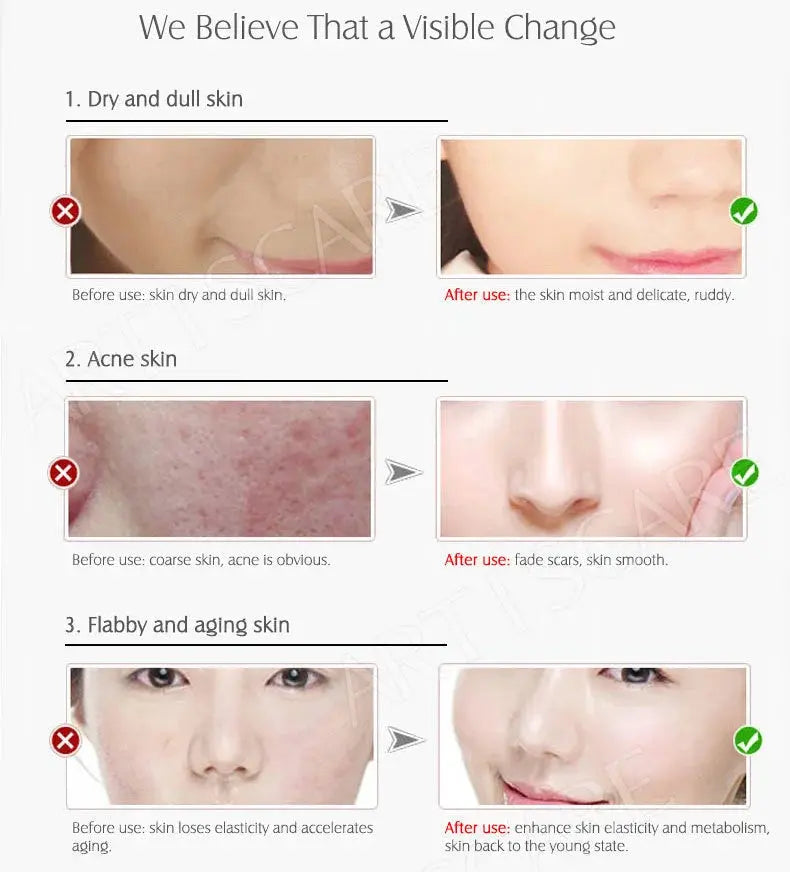 ARTISCARE Vitamin C Serum for Face Moisturizing 4Pcs Hyaluron Acid Facial Care Nourishing Essence SkinCare Products - Nova Trendz