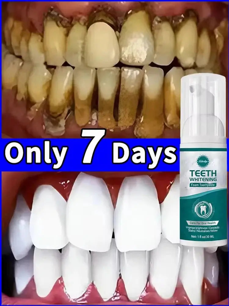 Tartar removers dissolves tartar and eliminates stains - Nova Trendz