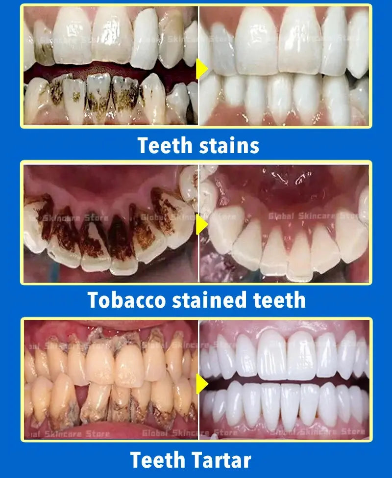 Tartar removers dissolves tartar and eliminates stains - Nova Trendz