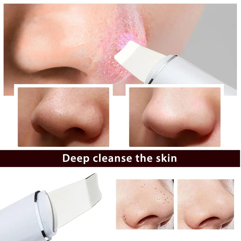 Skin Scrubber Ultrasonic Facial Machine for Home Use Spatula for Blackhead Remover Shovel Peeling Pore Cleaner Face Lift Massage - Nova Trendz
