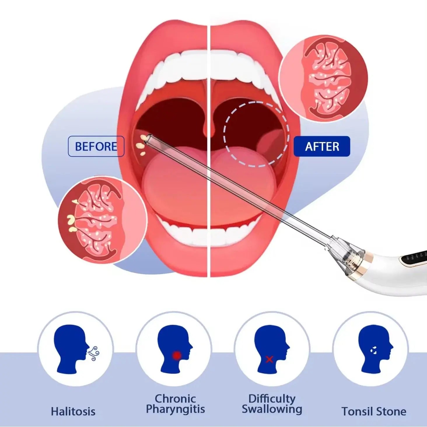 Electronic Vacuum Tonsil Stone Remover Kit with 5 Suction Modes 10in1 Tonsil Stone Cleaner Mouth Cleaning Tool Oral Fresh Care Nova Trendz