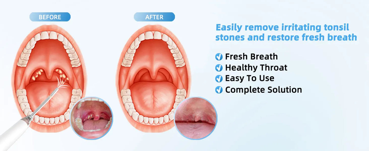 Electronic Vacuum Tonsil Stone Remover Kit with 5 Suction Modes 10in1 Tonsil Stone Cleaner Mouth Cleaning Tool Oral Fresh Care