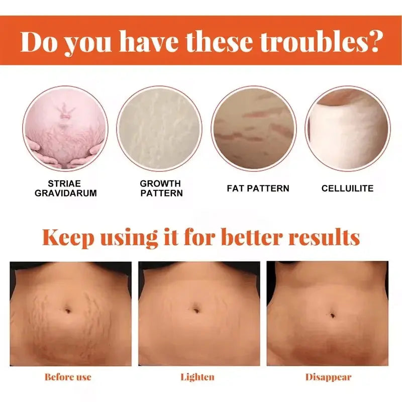 Stretch Marks Permanent Removal Cream Maternity Pregnant Women Pregnancy Anti-Winkle Smooth Repair Firming Skin Body Skin Care Nova Trendz