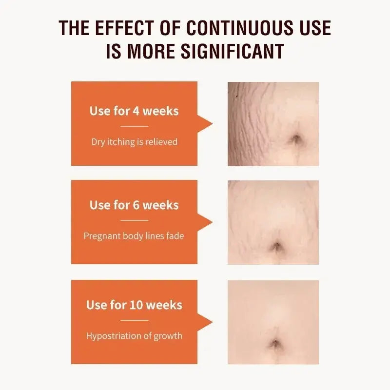 Stretch Marks Permanent Removal Cream Maternity Pregnant Women Pregnancy Anti-Winkle Smooth Repair Firming Skin Body Skin Care Nova Trendz