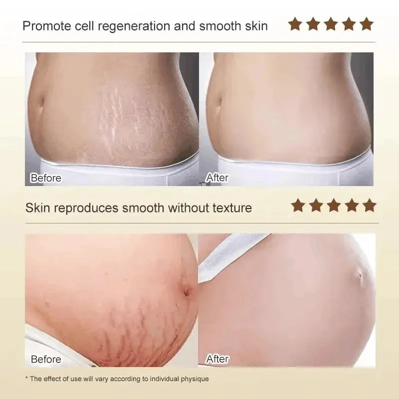 Stretch Marks Permanent Removal Cream Maternity Pregnant Women Pregnancy Anti-Winkle Smooth Repair Firming Skin Body Skin Care Nova Trendz