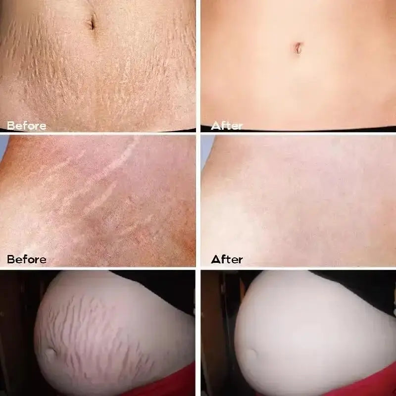 Stretch Marks Permanent Removal Cream Maternity Pregnant Women Pregnancy Anti-Winkle Smooth Repair Firming Skin Body Skin Care Nova Trendz
